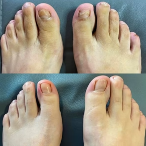 NeoClear™ COMPRE 2 Y RECIBA 5 - ¡El dispositivo nº 1 contra los hongos de las uñas!